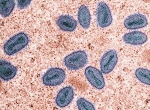 Impact of Monkeypox